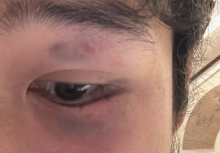 阮奇龙报平安 头部遭任意球重击后出现头晕呕吐症状